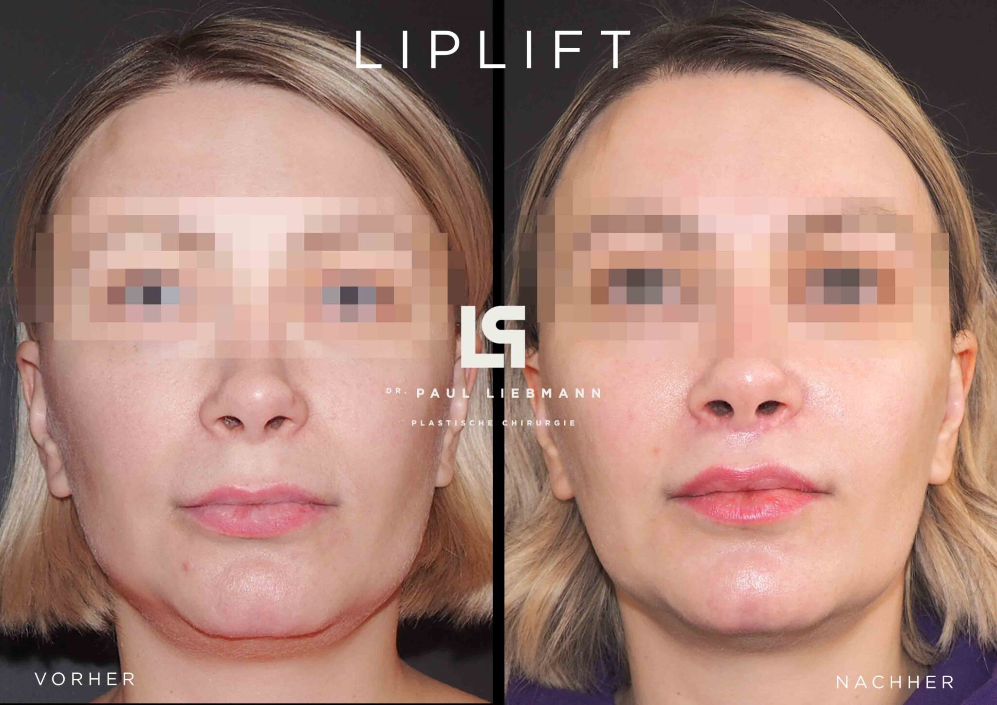 ᑕ ᑐ Bullhorn Lip Lift Wien ️ Informationen & Kosten